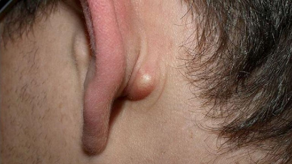 Những điều cần biết về u bã đậu ở tai