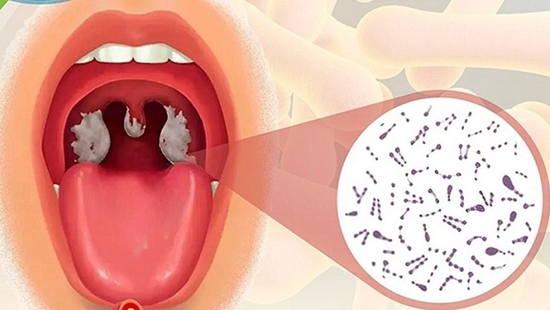 Lớp giả mạc do khuẩn bạch hầu tạo nên