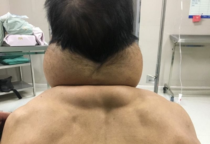 biểu hiện bệnh u mỡ đối xứng