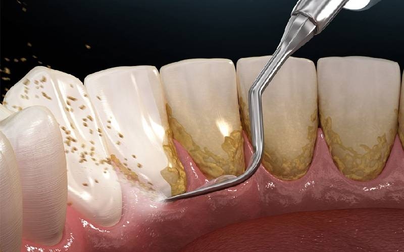Cạo vôi răng giá thế nào