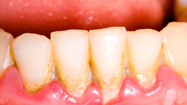 Cạo vôi răng giá thành hiện nay và những lưu ý khi thực hiện