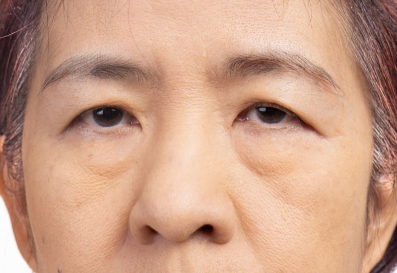 Sụp mí mắt là tình trạng mí mắt trên sa xuống thấp hơn vị trí bình thường, che khuất một phần con ngươi, gây cản trở tầm nhìn. 