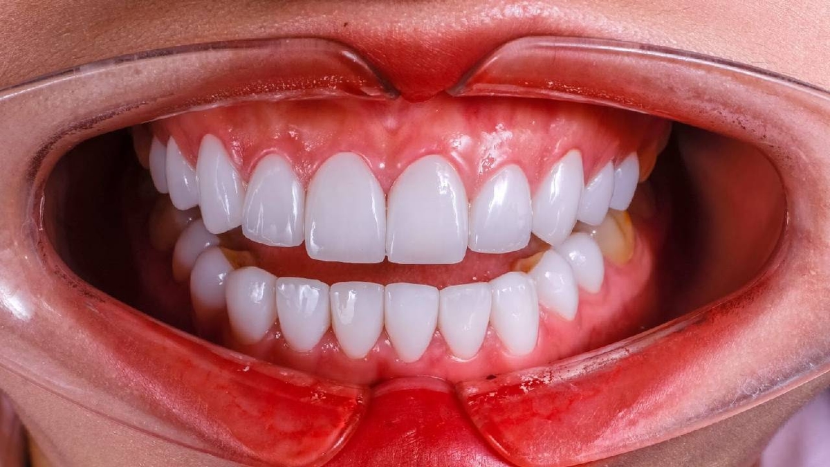 Giá dán sứ veneer &#8211; Chi phí cho nụ cười hoàn hảo