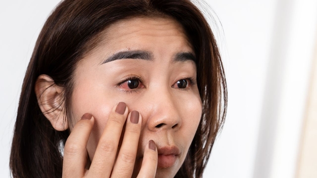 Nguyên nhân bị đau mắt đỏ: Điểm danh 3 &#8220;thủ phạm&#8221; chính