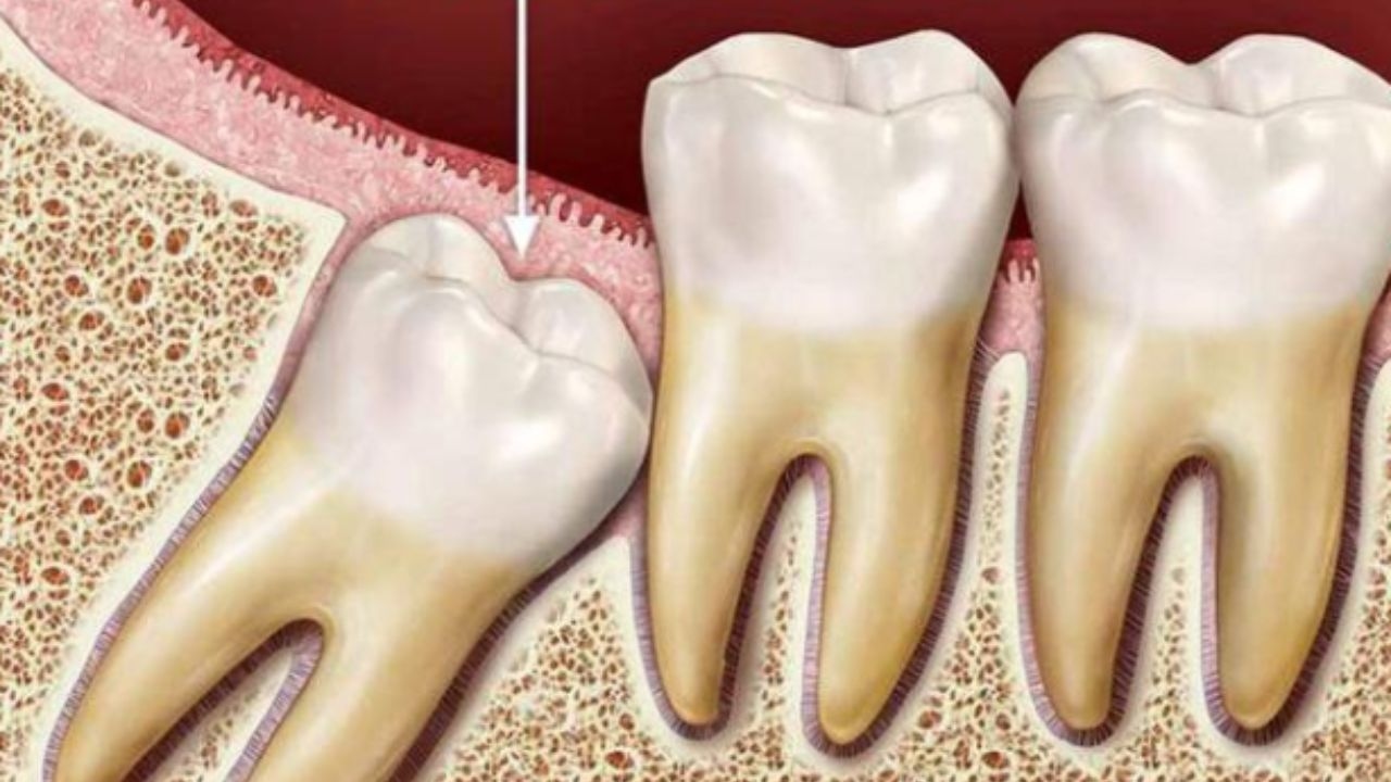 Nhổ răng khôn mọc lệch &#8211; Giải pháp toàn diện cho răng miệng