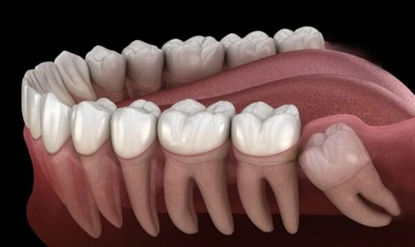 Răng khôn bị mọc lệch chủ yếu là do thiếu không gian.