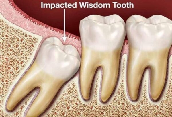 Răng khôn cần được nhổ nếu xuất hiện các vấn đề tiêu cực.