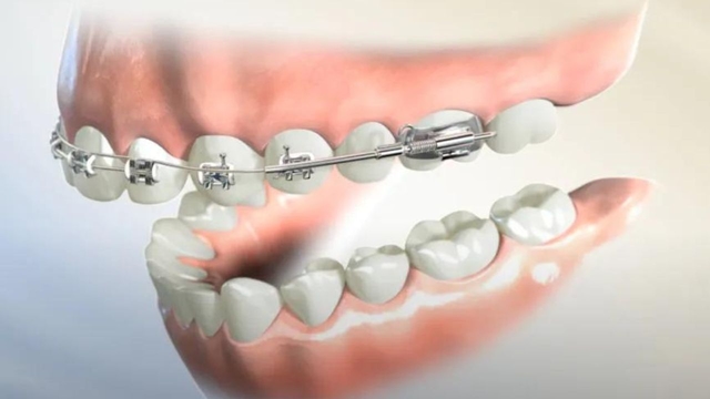 Niềng răng giá rẻ và những điều cần lưu ý