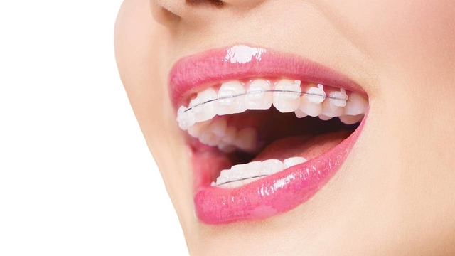 Niềng răng hô hàm trên &#8211; Những thông tin cần thiết