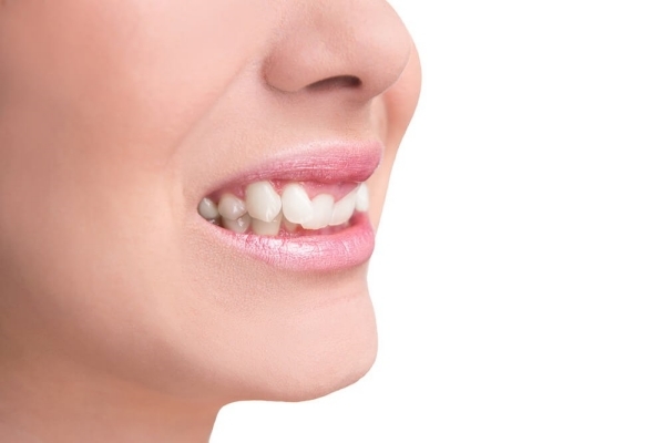 Niềng răng giúp xử lý vấn đề lệch lạc của răng khểnh.