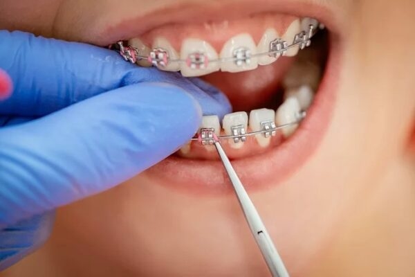 Niềng răng mắc cài kim loại cũng có nhiều ưu điểm, nhất là về chi phí.