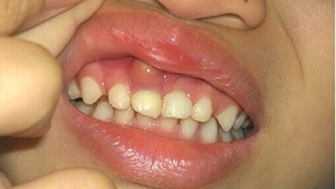 Sưng lợi hàm trên răng cửa và những cảnh báo răng miệng
