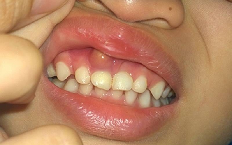 Sưng lợi hàm trên răng cửa vì sao