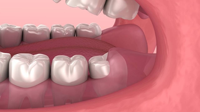 Sưng nướu răng cùng &#8211; Nỗi ám ảnh của nhiều người