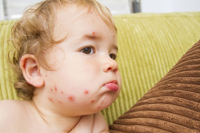 Tuy hiếm nhưng biến chứng của thủy đậu khá nguy hiểm.