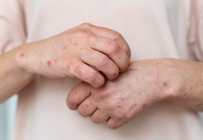 Dị ứng vắc-xin là gì?