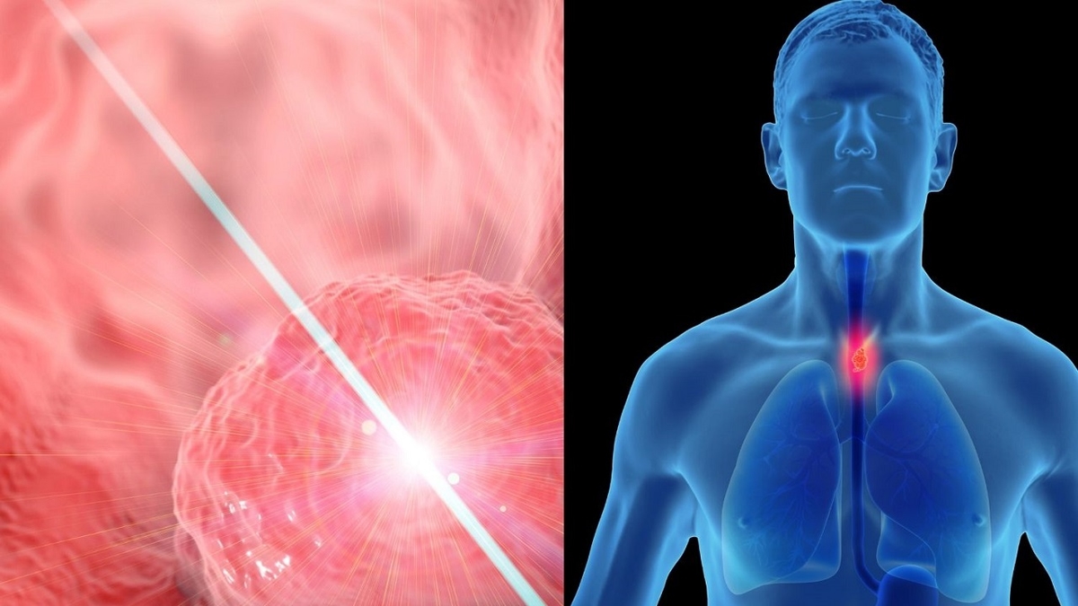Khó thở nuốt nghẹn: Cảnh báo ung thư thực quản đến rất gần!