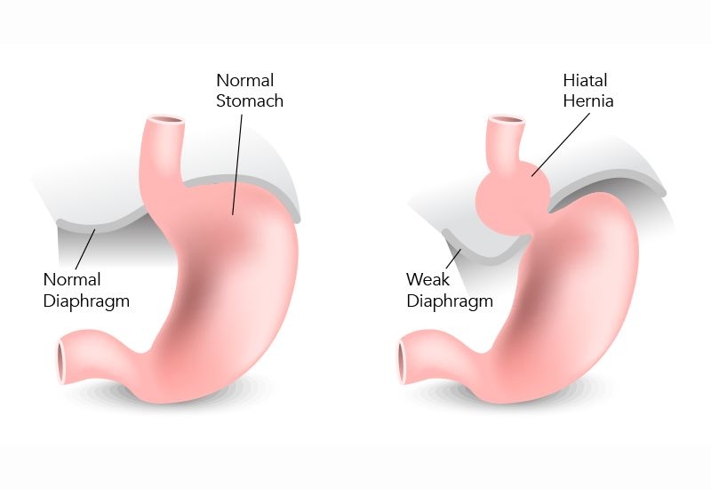 Ợ nóng sau khi ăn: Dấu hiệu của bệnh lý tiêu hóa?