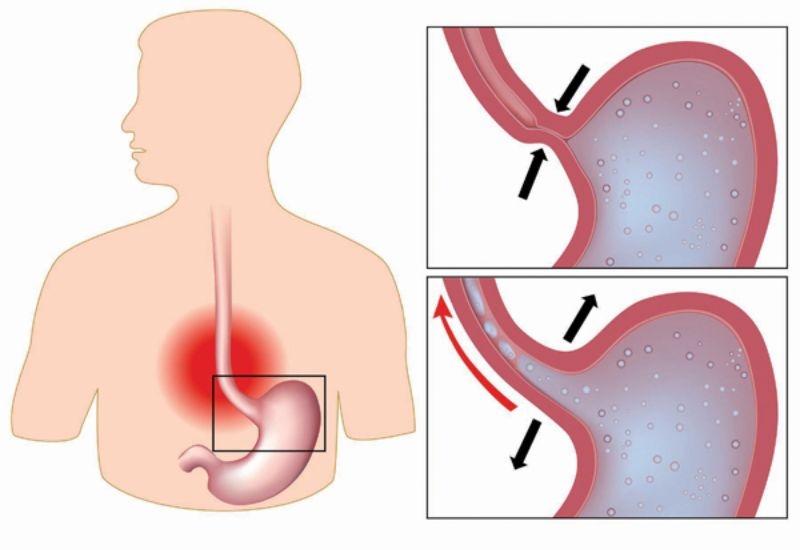 Hiểu rõ về trào ngược dạ dày thực quản