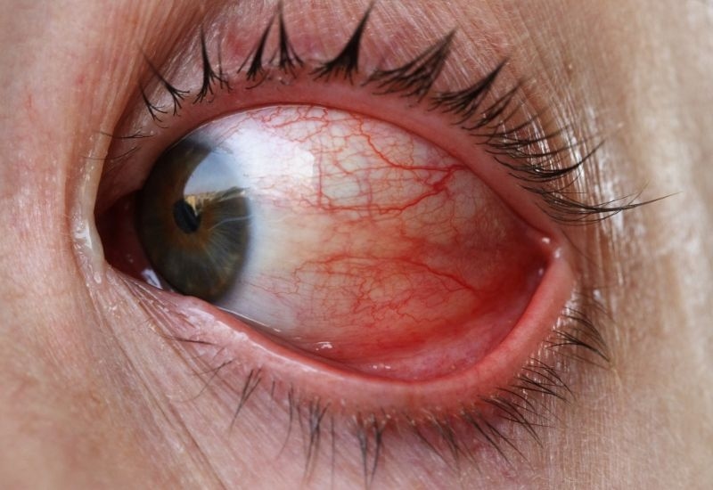 Rủi ro nhiễm trùng của phương pháp trị đau mắt đỏ bằng rau răm
