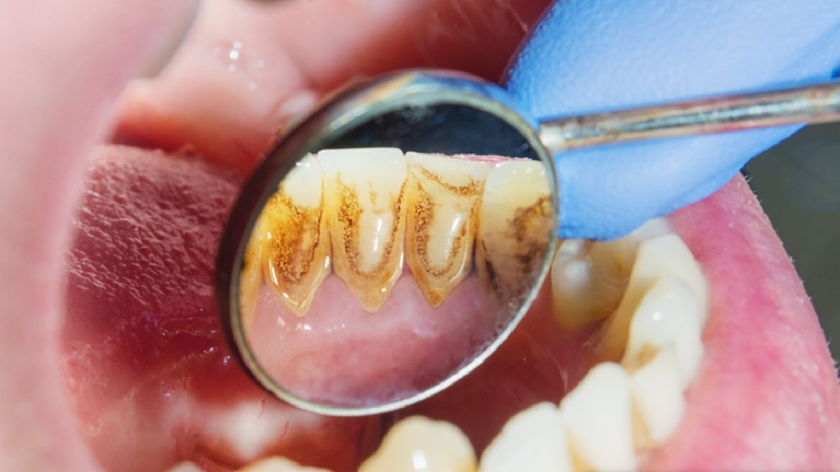 Tự làm sạch cao răng tại nhà &#8211; Cân nhắc trước khi thực hiện