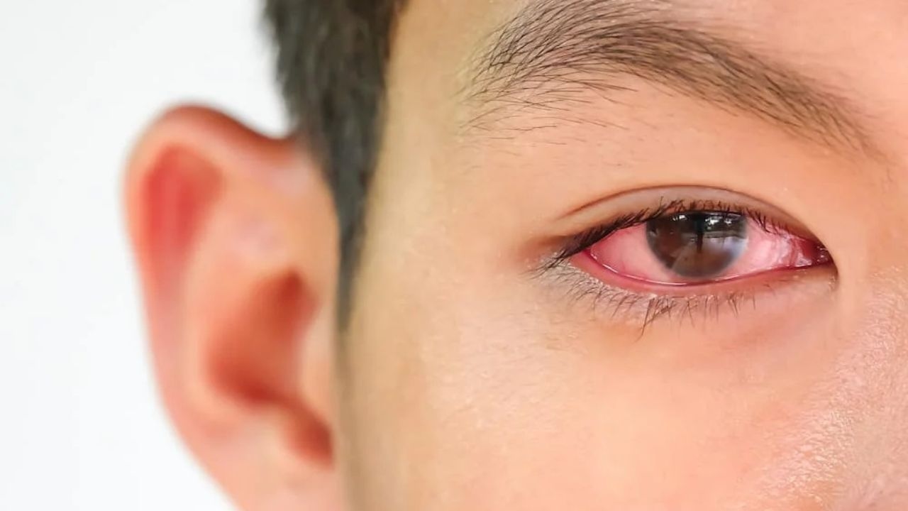 Giải đáp câu hỏi nguyên nhân, triệu chứng đau mắt đỏ là gì?