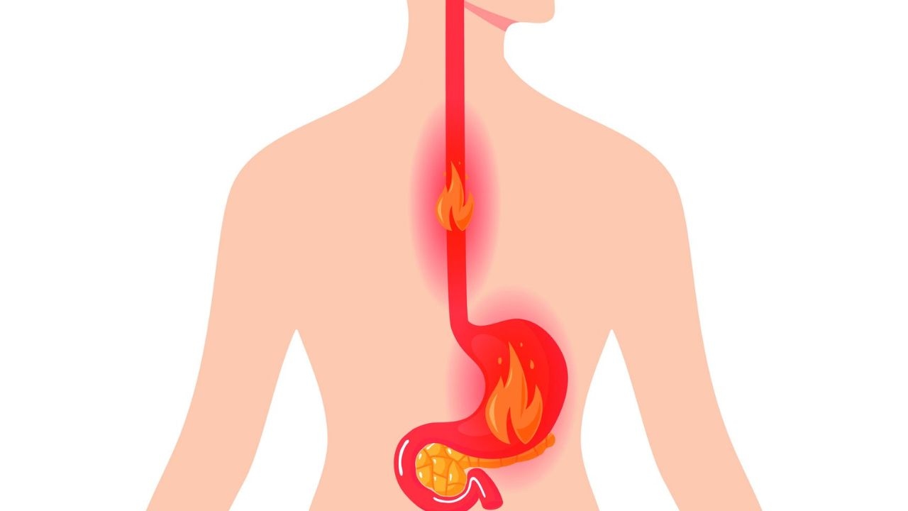 Đo PH24H &#8211; Cứu cánh cho người bị ợ chua nóng rát cổ lâu năm