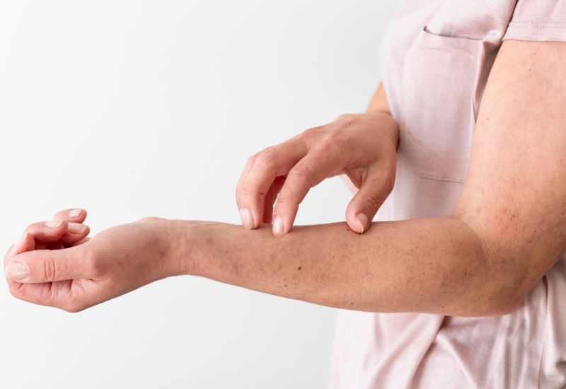 Nguyên nhân tiêm vắc-xin bị nổi mẩn đỏ