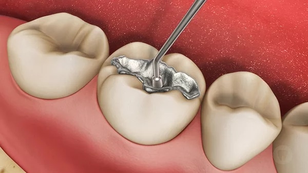 Trám răng thẩm mỹ bao nhiêu tiền sẽ phụ thuộc vào nhiều thứ.