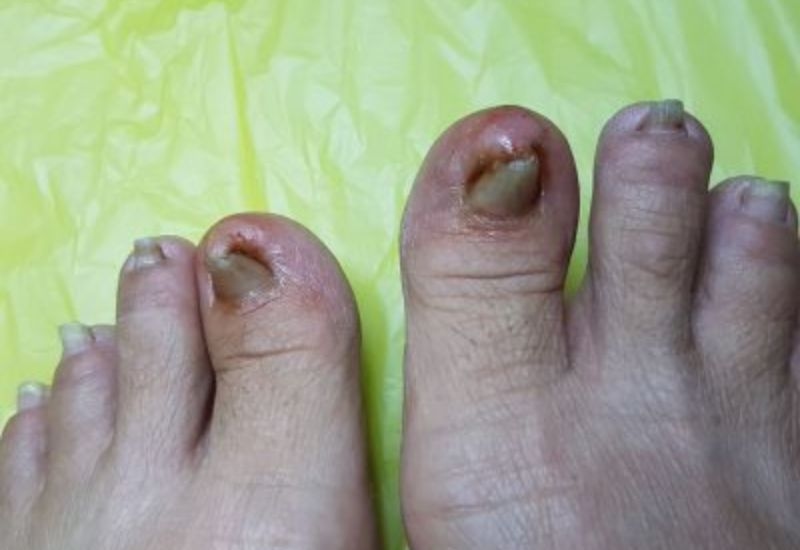 xử lý móng quặp tại nhà sai cách dễ dẫn tới tháo móng.