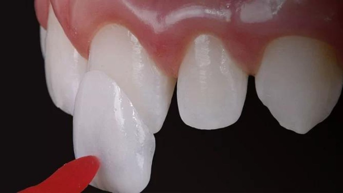 Giá dán sứ veneer dành cho ai đang tìm hiểu