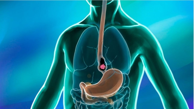 Tìm hiểu ợ nóng có hại không, nguyên nhân và cách điều trị
