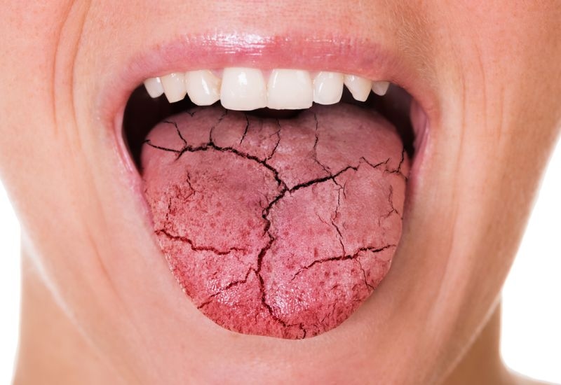 Khô miệng và nuốt khó: Triệu chứng không thể xem nhẹ