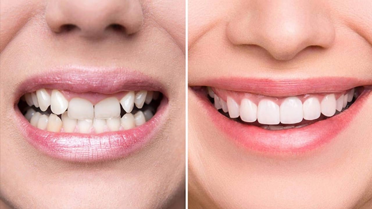 Bọc răng sứ 2 hàm giá bao nhiêu &#8211; Tìm hiểu ngay