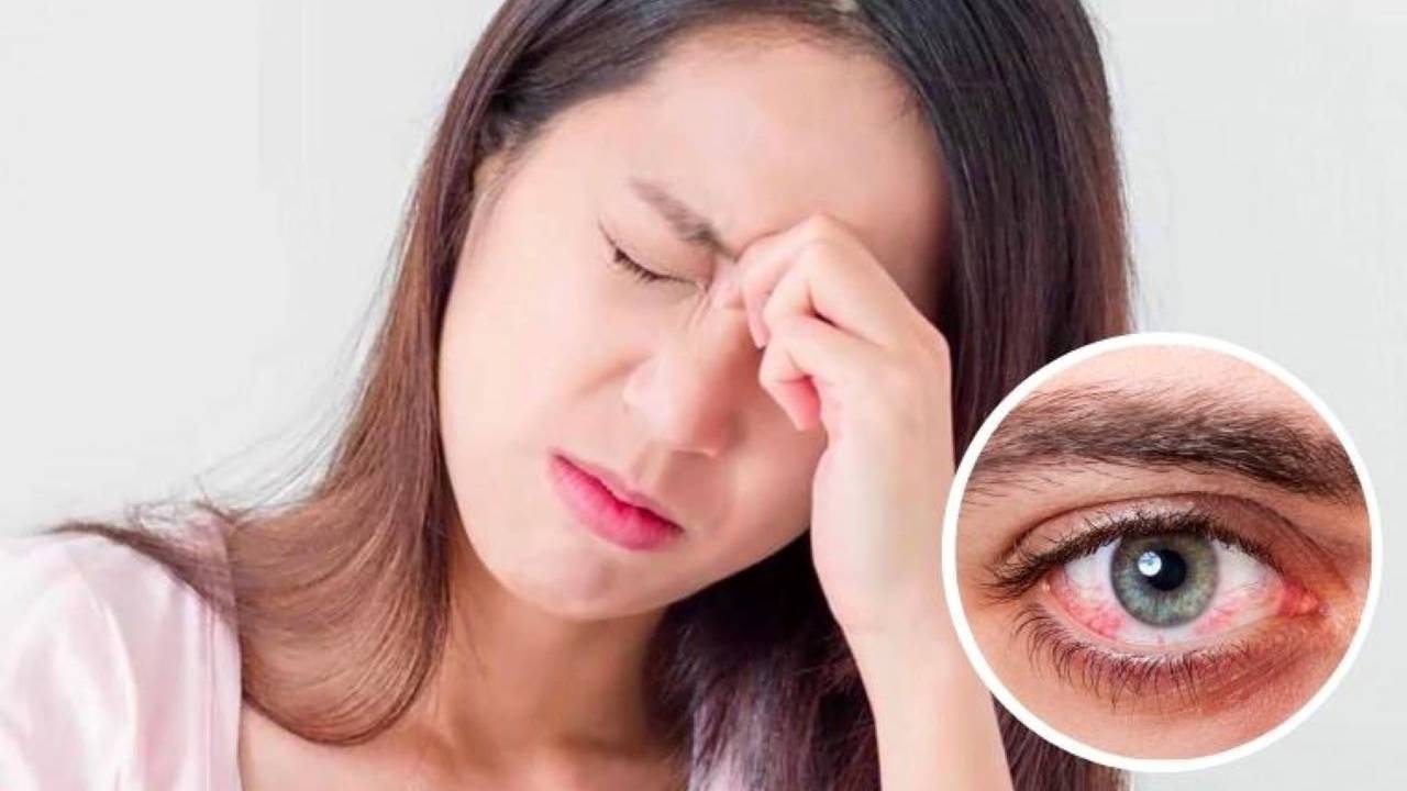 Đau mắt đỏ triệu chứng thế nào &#8211; Tìm hiểu ngay