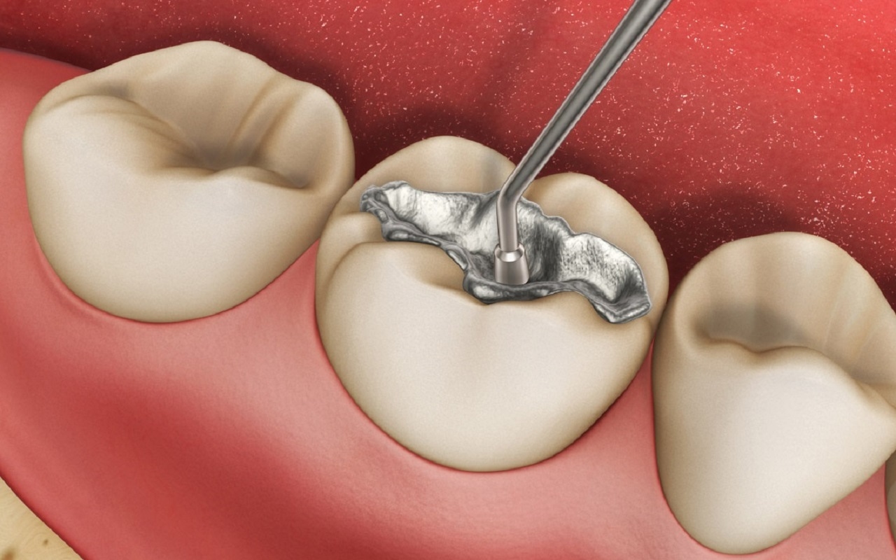 Tìm hiểu về quy trình hàn răng sâu