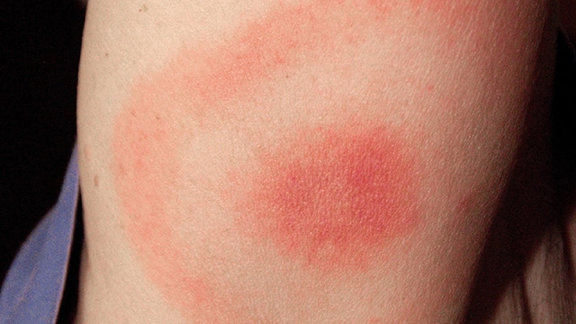 Tiêm vacxin có biểu hiện gì? Những dấu hiệu bạn cần biết