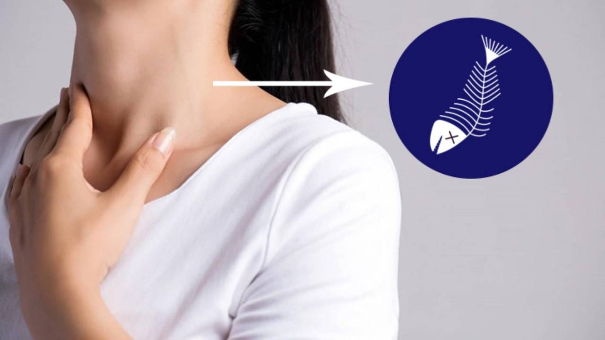 Xương cá dính cổ họng: Nguyên nhân, hậu quả và cách xử lý