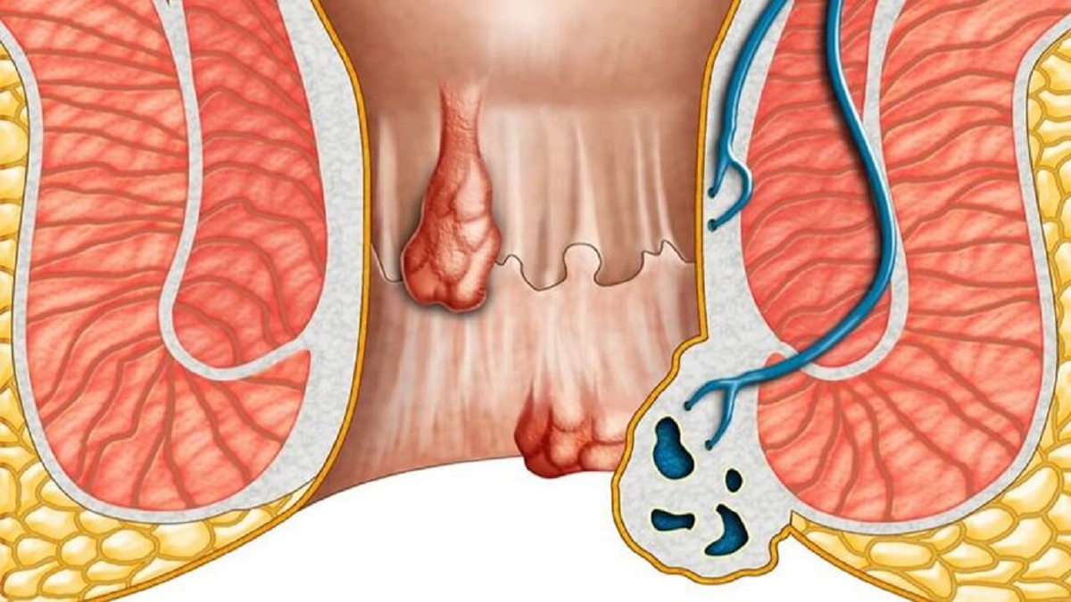 Chữa khỏi bệnh trĩ được không: Điều cần biết để trị dứt điểm