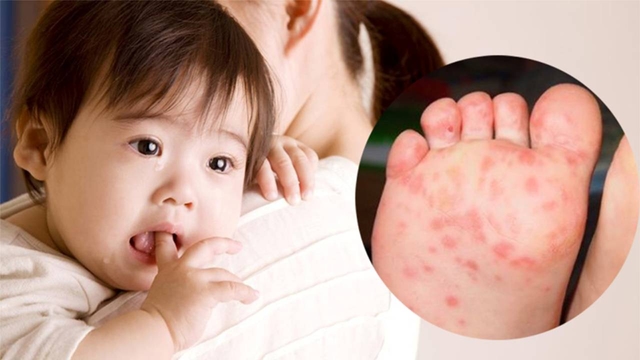Dấu hiệu bị tay chân miệng ở trẻ em &#8211; Cha mẹ lưu ý