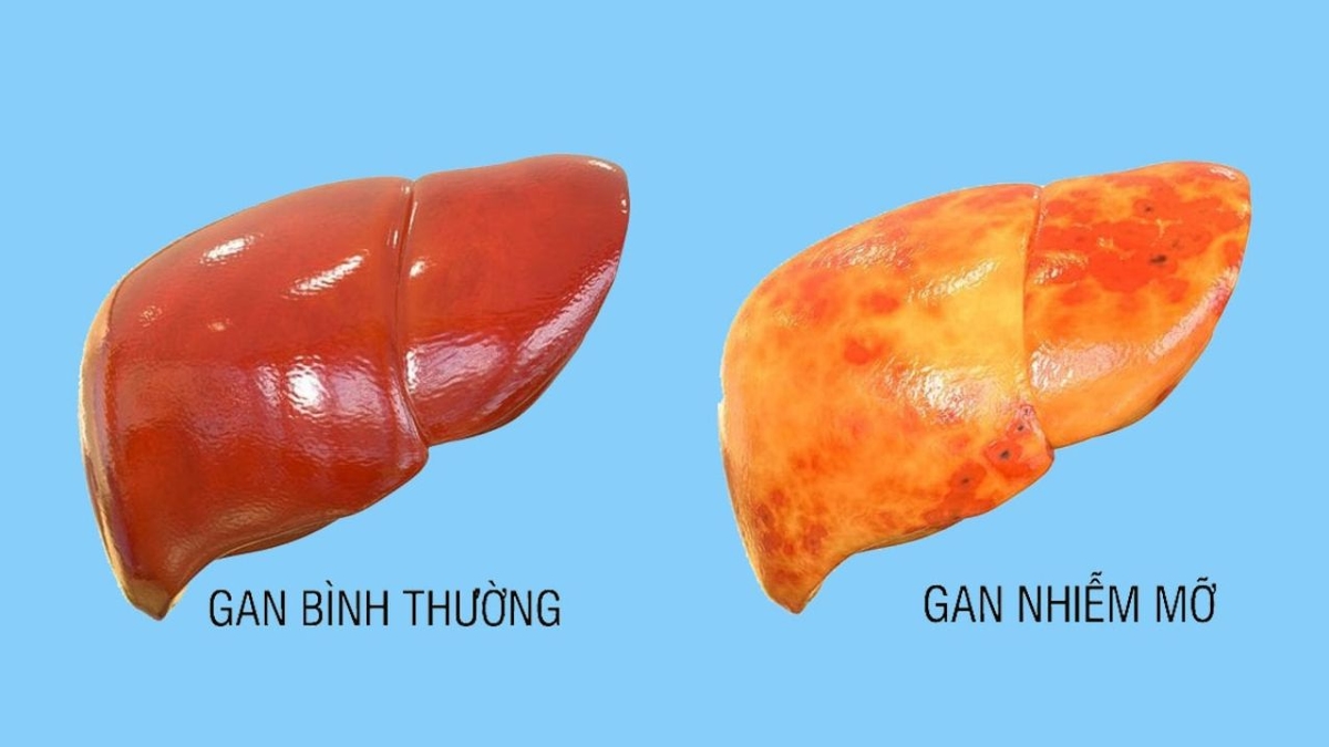 Nguyên nhân gan nhiễm mỡ: Không phải chỉ do ăn nhiều chất béo