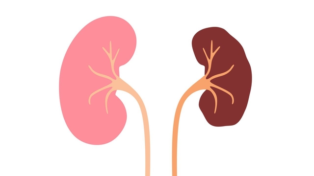 Thận ứ nước độ 3: Những câu hỏi thường gặp và giải đáp chi tiết