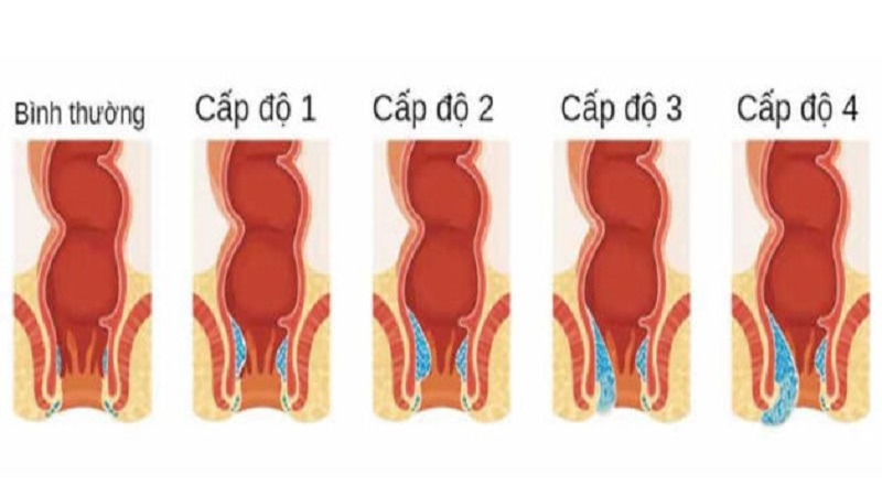 Trĩ nội có cần phẫu thuật, điều trị cần chú ý điều gì?