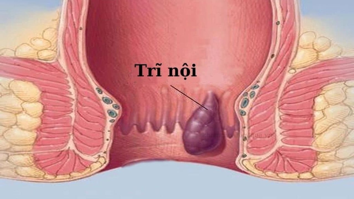 Hiểu về trĩ nội và cách điều trị: Những điều bạn cần biết