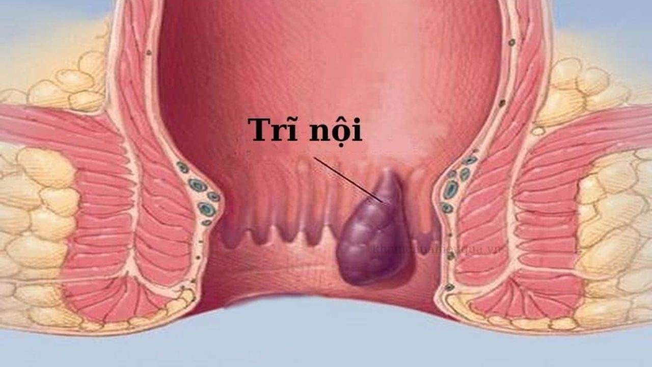 bệnh trĩ nội và cách điều trị