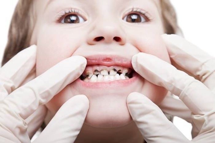 Bệnh lý răng trẻ em ảnh hưởng không nhỏ tới sức khỏe nên cần được thăm khám và điều trị sớm