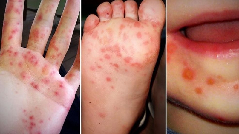 Nguyên nhân bệnh là do virus và có nhiều nguy cơ khiến trẻ bị bệnh.