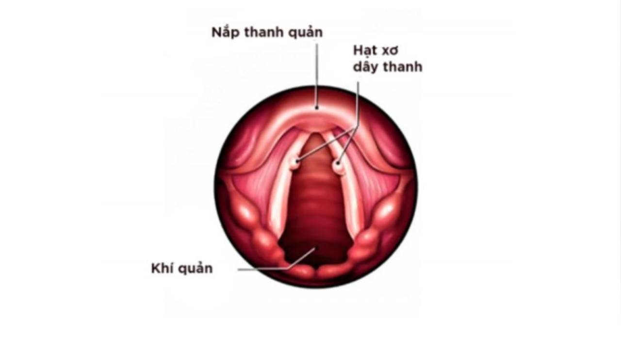Cắt hạt xơ dây thanh kiêng nói bao lâu &#8211; Bác sĩ giải đáp
