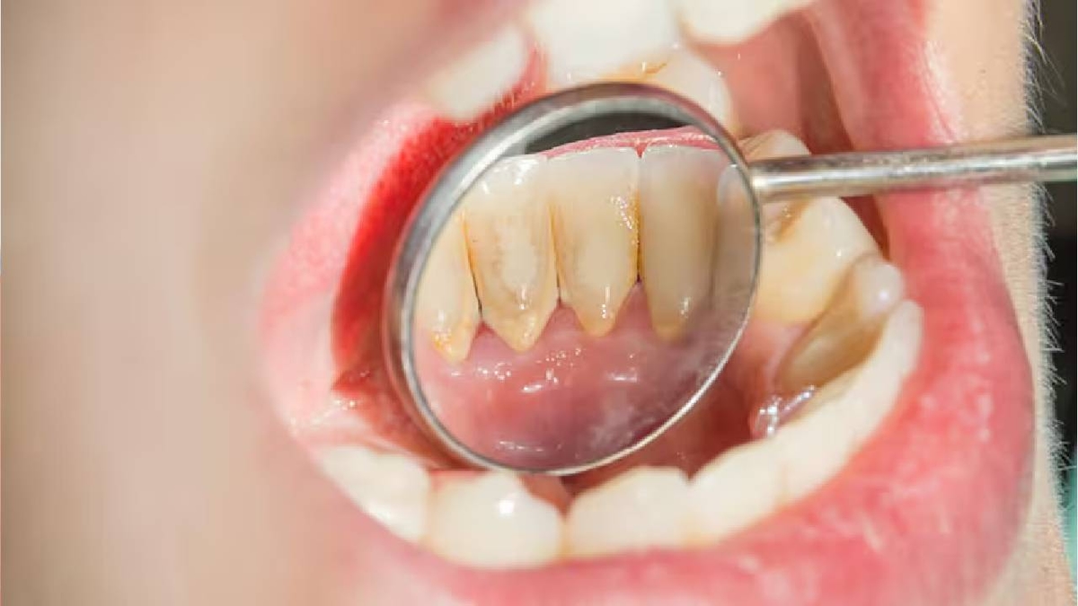 Chữa cao răng đúng cách và những lưu ý