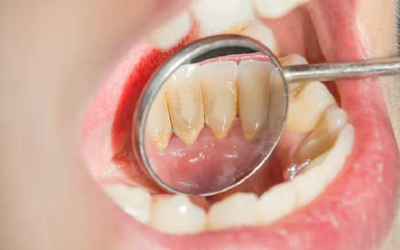 Cách chữa cao răng